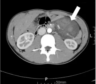 Fig.  2.  Surgical  findings.  A  large  mass,  8  cm  in  diameter,  was  lo- lo-cated  in  mesentery  of  small  intestine