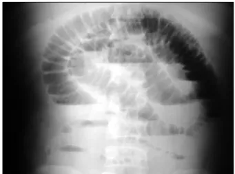Fig.  1.  Plain  abdominal  film  (upright)  shows  multiple  air-fluid  lev- lev-els  arranged  in  a  stepwise  pattern.