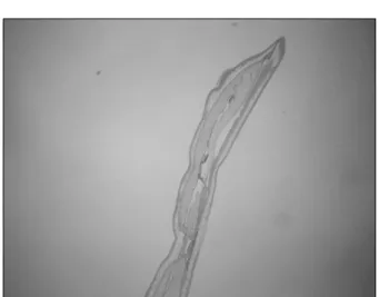 Fig.  2.  CT  scan  shows  dilated  small  bowel  loops  filled  with  fluid 