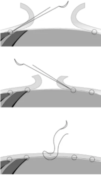 Fig.  1.  Quilting  technique.  As  the  flap  was  advanced,  multiple  rows  of  sutures  were  placed  from  the  subcutaneous  tissue  to  underlying  periosteum  of  ribs  and  muscle