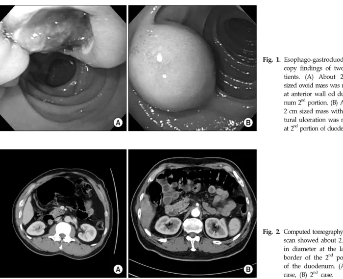 Fig. 1. Esophago-gastroduodenos copy  findings  of  two   pa-tients.  (A)  About  2  cm  sized  ovoid  mass  was  noted  at  anterior  wall  od   duode-num  2 nd   portion