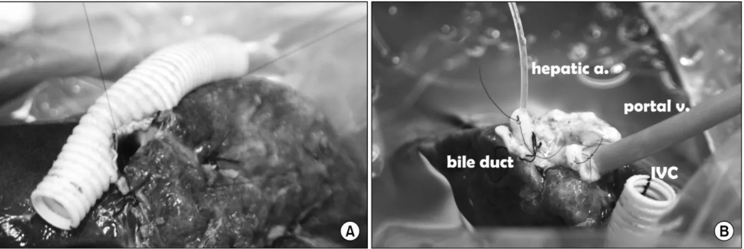 Fig.  2.  (A)  The  infrahepatic  IVC  of  left  liver  was  reconstructed  with  vascular  prosthesis