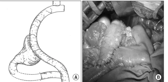 Fig.  1.  (A)  Illustration  of  proximal  gastrectomy  with  double  tract  reconstruction  using  remnant  antrum