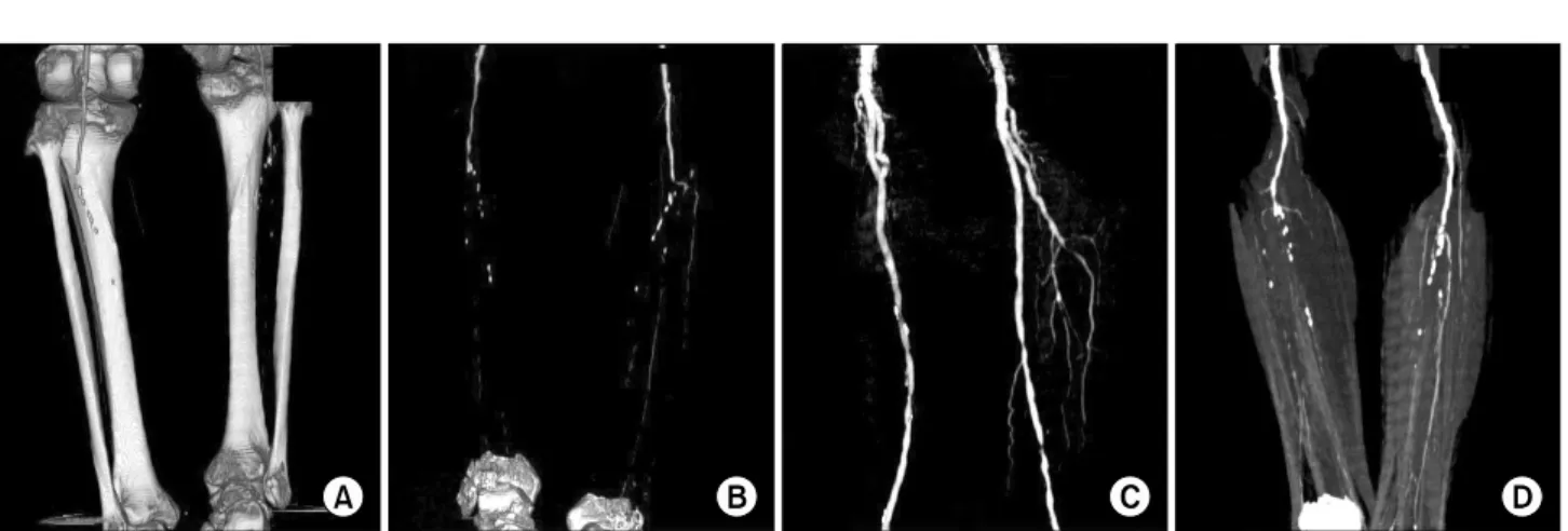 Fig.  3.  Male  patient  of  71  years  old.  (A)  Multi-Detector  Row  Helical  Computed  Tomography  Angiogram  AP  view  shows  high  grade  stenosis  at  bilateral  anterior  tibial  arterys  and  peroneal  arterys,  occlusion  of  bilateral  posterior