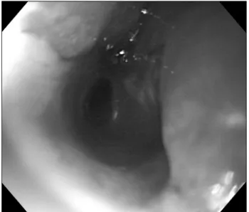 Fig.  1.  The  lumen  has  a  friable  nature  on  manipulation  along  with  stenotic  configuration  in  2 nd   portion  of  the  duodenum.