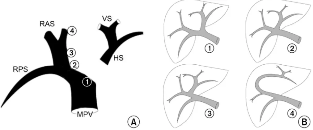 Fig.  2.  Primary  portal  ramification  patterns  at  the  hilum  are  determined  by  the  “sliding”  characteristics  of  the  reunion  point  of  the  left  portal  vein
