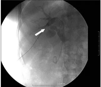 Fig. 1. Preoperative  percutaneous  transhepatic  biliary  drainage. 