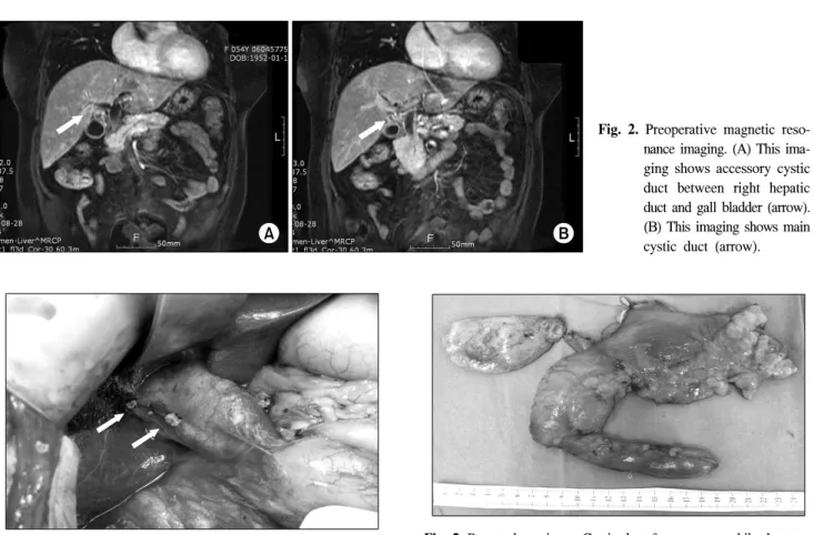 Fig.  5.  Resected  specimen.  Cystic  duct  from  common  bile  duct  was  resected  with  specimen  and  the  other  from  right  hepatic  duct  remained.