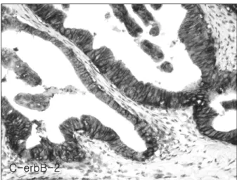 Fig.  1.  Immunohistochemical  staining  for  C-erbB-2  in  adenocar- adenocar-cinoma  of  common  bile  duct  shows  positive  reaction  with  membranous  pattern  (ABC,  ×400).