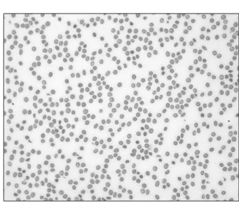 Fig.  2.  Peripheral  blood  smear  showing  red-cell  fragmentation  and  thrombocytopenia  (Wright  stain,  ×400).