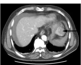 Fig.  2.  Gross  specimen  consists  of  a  well-demarcated,  solid  firm  mass  measureing  approximately  4×5×4  cm  with  ruptured  capsule  at  lower  pole