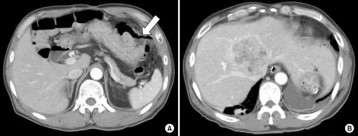 Fig.  l.  Computed  Tomography  images.  (A)  Fluid  collection  by  perforation  of  previous  gastrojejunostomy  site  (arrow)