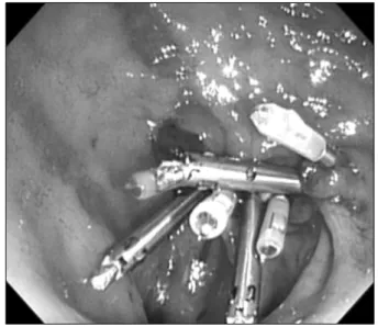 Fig. 3. The cystic duct was identified and ligated using endoclips.