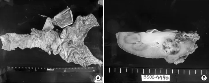 Fig.  5.  Gastroscopic  finding.  2.0  cm  sized  polypoid  and  depressed  lesion  with  abnormal  converging  fold