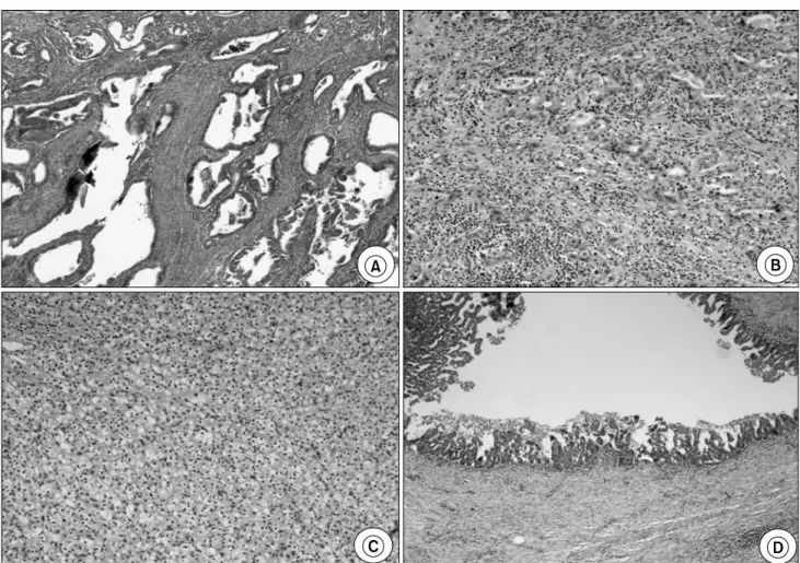 Fig.  7.  Histopathologic  findings.  (A)  Adenocarcinoma  of  the  ampular  of  Vater