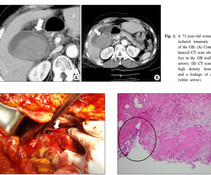 Fig.  2.  Surgical  finding.  Picture  shows  a  traumatic  rupture  (white  arrow)  of  GB  wall.