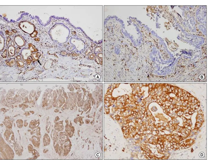 Fig.  1.  (A)  Immunohistochmical  staining  pattern  for  normal  gallbladder  mucosa  and  carcinoma