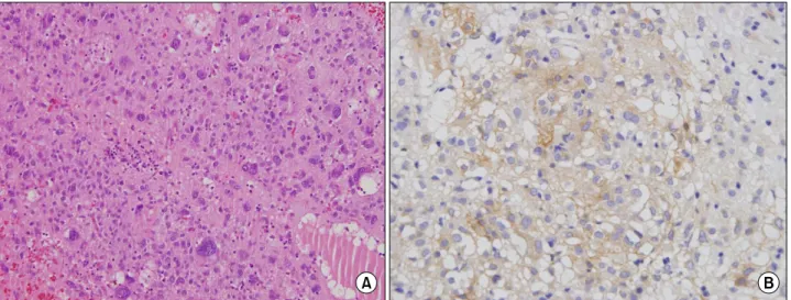 Fig.  3.  Pathologic  findings.  (A)  Histologically,  the  tumor  is  composed  of  short  spindle-shaped  and  oval  cells  (H&amp;E,  ×200)