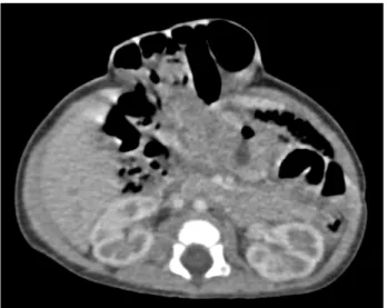 Fig.  1.  This  image  of  the  patient  showes  epigastric  mass  that  con- con-sisted  of  upper  blue  color  mass  and  lower  brown  color  mass