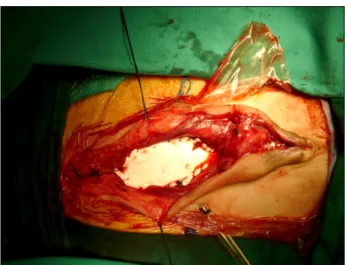 Fig.  4.  Sternal  repair  by  using  Gortex  patch  is  shown  in  this  picture. 하였는데 수술 전 61%였던 심박출률이 수술 이틀 후에 시 행한 심초음파 검사에서 31%로 감소되었으나 수술 26일 후 에 다시 시행한 심초음파 검사에서 50%로 회복되었다