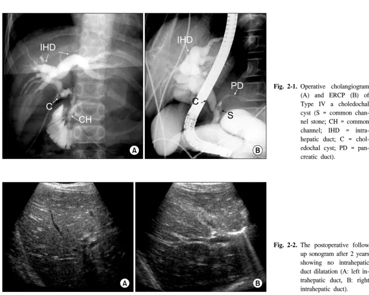 Fig. 2-1. Operative  cholangiogram  (A)  and  ERCP  (B)  of  Type  IV  a  choledochal  cyst  (S  =  common   chan-nel  stone;  CH  =  common  channel;  IHD  =   intra-hepatic  duct;  C  =   chol-edochal  cyst;  PD  =   pan-creatic  duct).