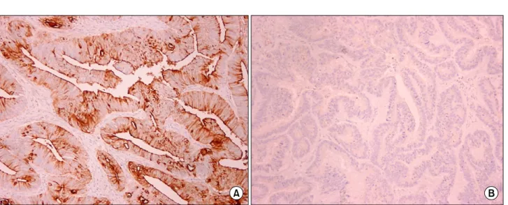 Fig.  1.  Immunohistochemical  staining  with  Anti-CA  19-9  Antibody.  (A)  Representative  photomicrograph  of  a  colonic  adenocarcinoma  show- show-ing  strong  cytoplasmic  CA19-9  expression  (×100)