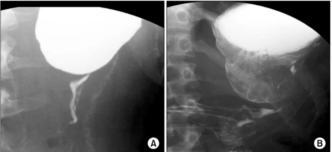 Fig.  3.  Schematic  drawing  of  placements  of  trocars.  A  11-mm  tro- tro-car  (11)  inserted  through  a  peri-umbilical  wound,  and  a  12-mm  trocar  (12)  is  inserted  above  and  to  the  right  of  the  umbilicus