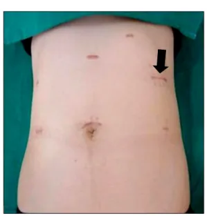 Fig.  5.  Abdominal  wound  scar  at  2  month  postoperative  date. 