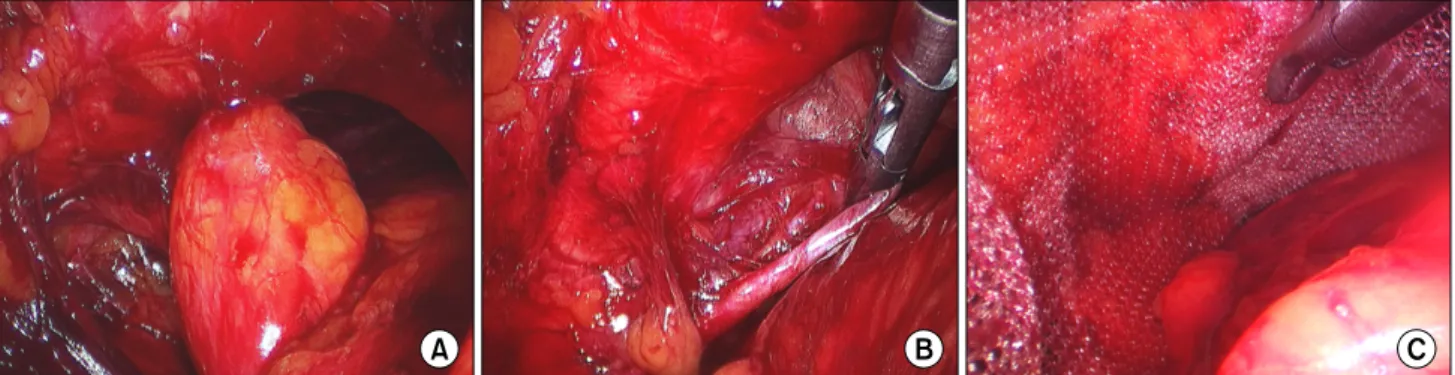 Fig.  3.  Laparoscopic  TEP  (Totally  extraperitoneal  laparoscopic  repair)  for  obturator  hernia
