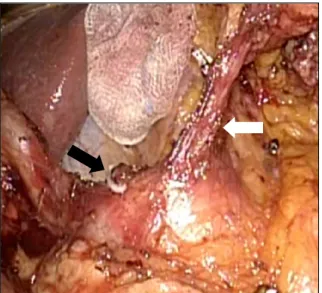 Fig.  2.  Operative  finding  after  dissection  of  lymph  node  around  celiac  axis