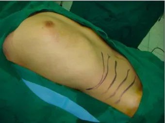 Fig.  2.  Large  chest  wall  defect  after  radical  excision.  The  large  chest  wall  defect  is  occurred  after  radical  mastectomy