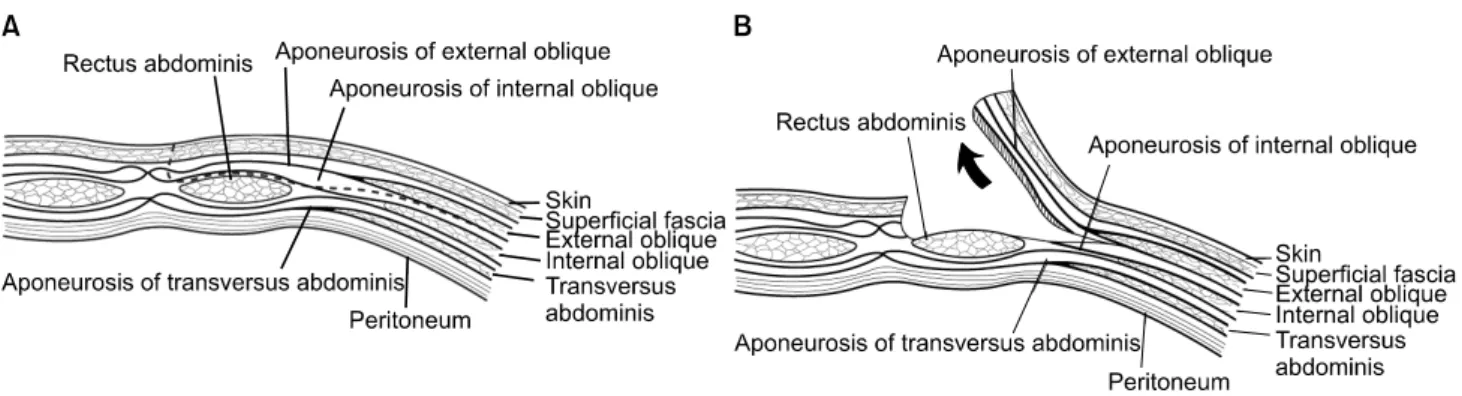 Fig.  3.  (A)  The  range  of  external  oblique  myocutaneous  flap.  The  dotted  line  is  revealed  the  range  of  external  oblique  myocutaneous  flap