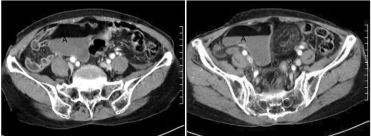Fig.  1.  Abdominal  CT  shows  a  fluid  collection  and  a  fat  fluid  level  in  pelvic  cavity  (A).
