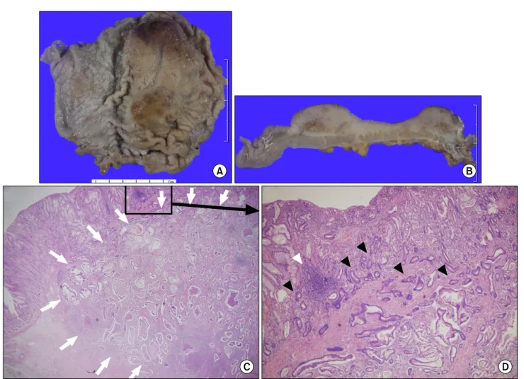 Fig.  2.  Pathologic  finding.  (A)  Gross  finding:  The  mucosal  surface  of  the  whole  body  shows  a  dome-shaped  elevated  lesion,  measuring  8.5×6.5  cm