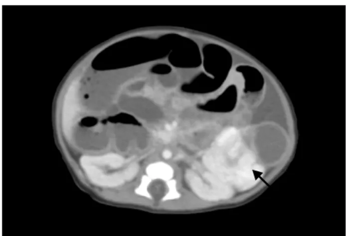 Fig.  3.  Abdominal  CT  scan  shows  a  3.5  cm  hyperdense  mass  at  the  splenic  flexure,  which  developed  bowel  obstruction.