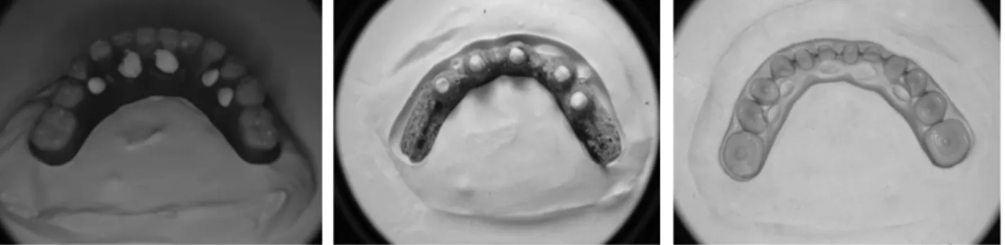 Figure 12. Artificial teeth on arrangement 