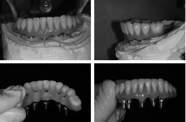Figure 15. Final screw and cement retained implant prosthesis 
