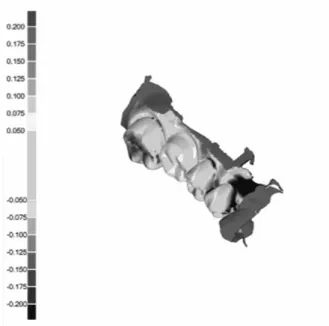 Figure 8.  Representative superimposition of scanned  cast(Bio3D) with reference data set(Nissin master 