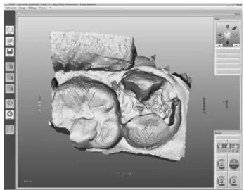 Fig. 5. Scanned maxillary dentition with improper handling with a scanner(IHS)