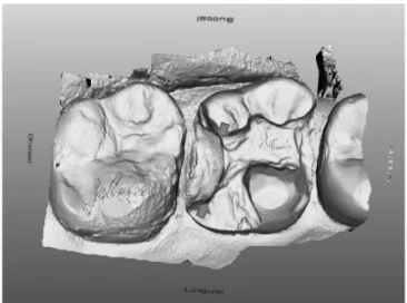 Fig. 6. Improper MOD cavity preparation on the maxillary first molar