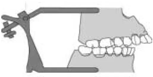 Fig. 9. Large simple hinge articulator mounted Balkwill angle enlarging(Type 4).