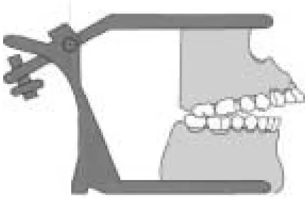 Fig. 12. Simple hinge articulator mounted superior THA deviation(Type c).