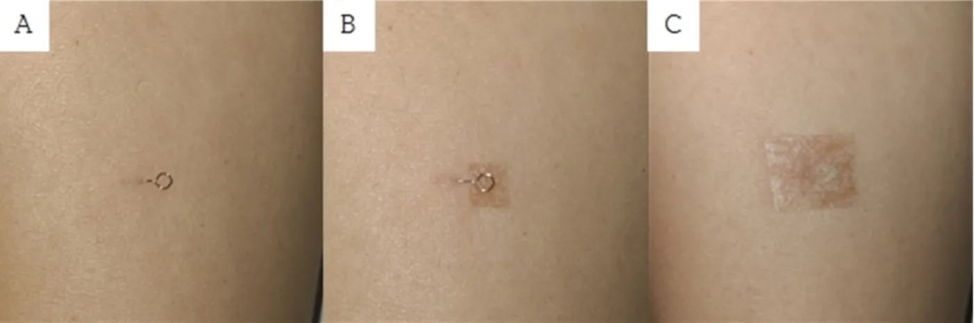 Fig.  2.  Process  of  intradermal  acupuncture.