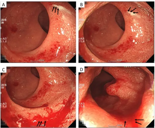 Fig.  1.  Colonoscopy  on  29  Feb  2016.