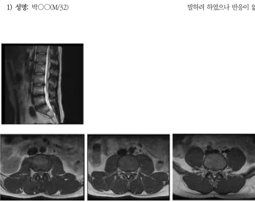 Fig.  1.  L-spine  MRI. 
