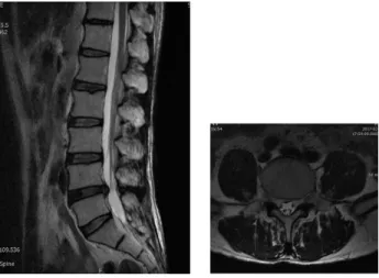Fig.  3.  L-spine  MRI. 