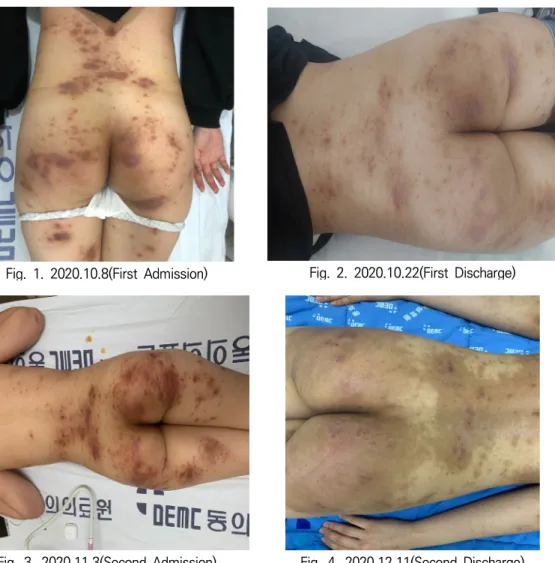Fig.  3.  2020.11.3(Second  Admission)  Fig.  4.  2020.12.11(Second  Discharge)  였고,  야간  소양감은  감소하였으나  환부의  화끈거리는 열감이  남아  있고,  병실이  더울  때  소양감이  심화된다고 하여 2020년 12월 4일부터 퇴원 시까지 黃蓮阿膠湯을 Qid 용법으로 사용하였다