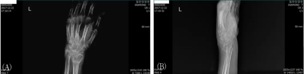 Fig.  1.  (A)  Left  wrist  x-ray  AP  view.
