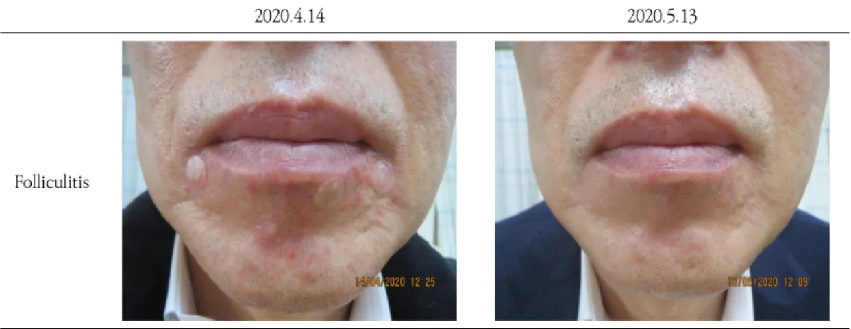 Fig.  2.  Clinical  Progress  of  Folliculitis