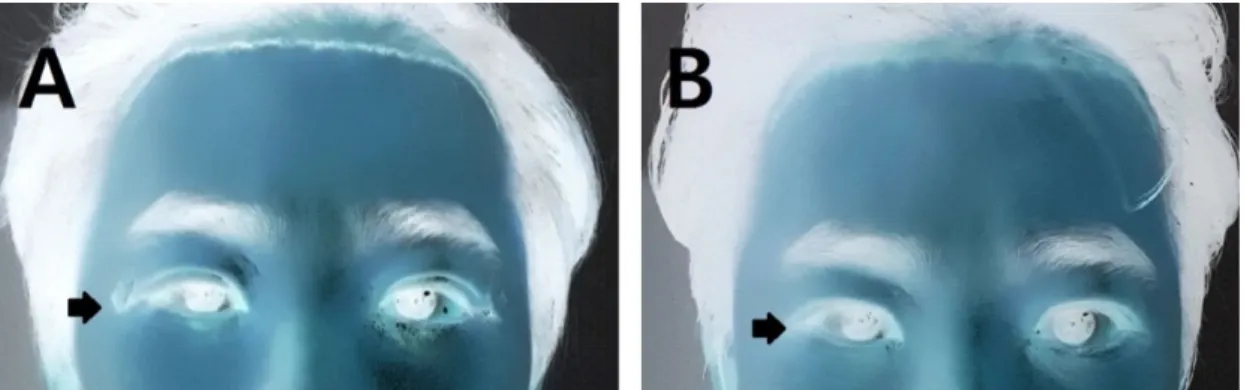 Fig. 1. Before  and  after  taking  Succium  decoction. 